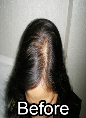 Before-Alopecia