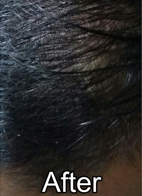 After-Androgenetic Alopecia
