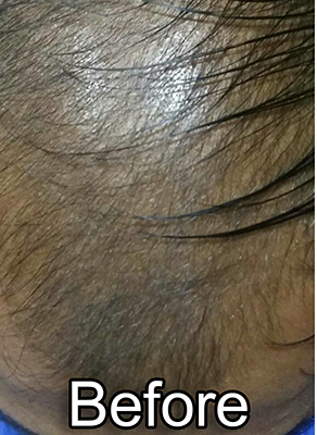 Before-Androgenetic Alopecia