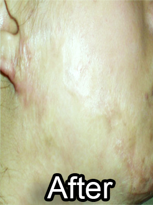 After-Keloid