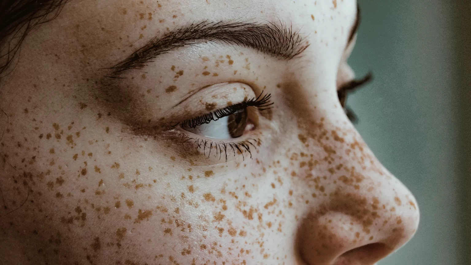 freckles treatment in indore