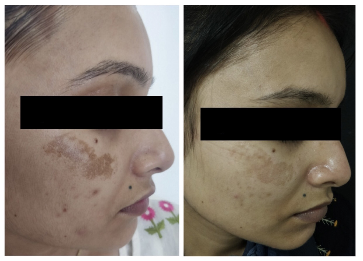 Best Melasma Treatment in indore