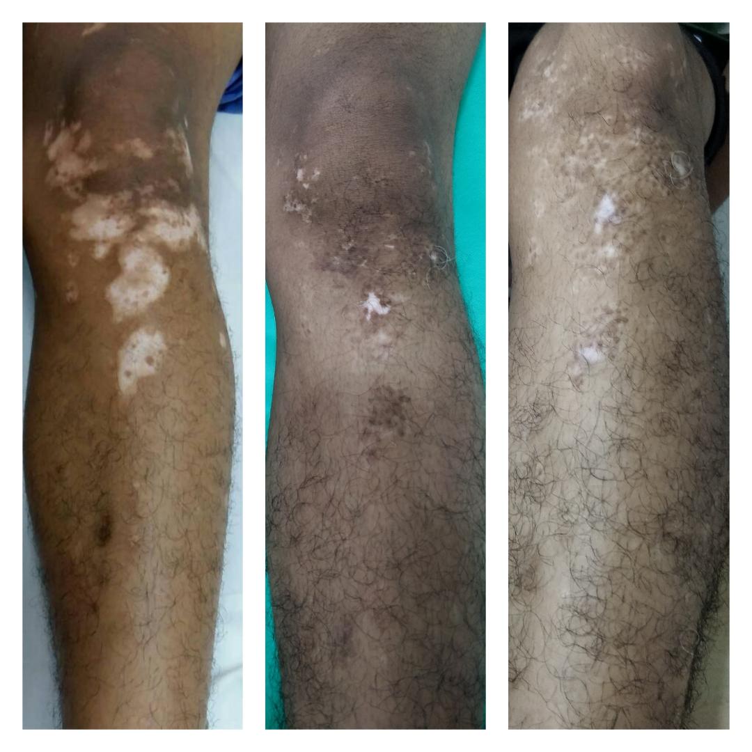 Vitiligo Treatment Indore
