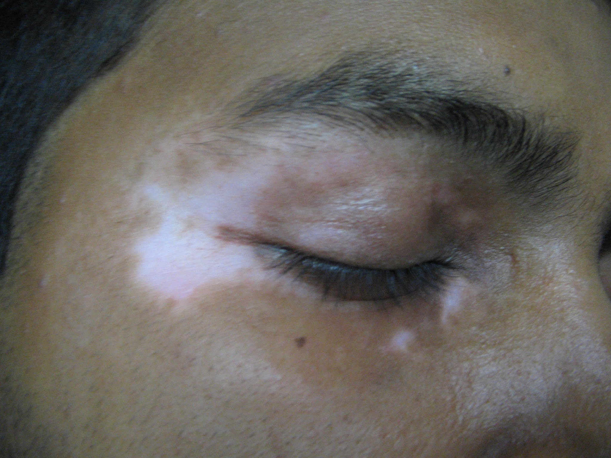 Vitiligo Treatment In Indore