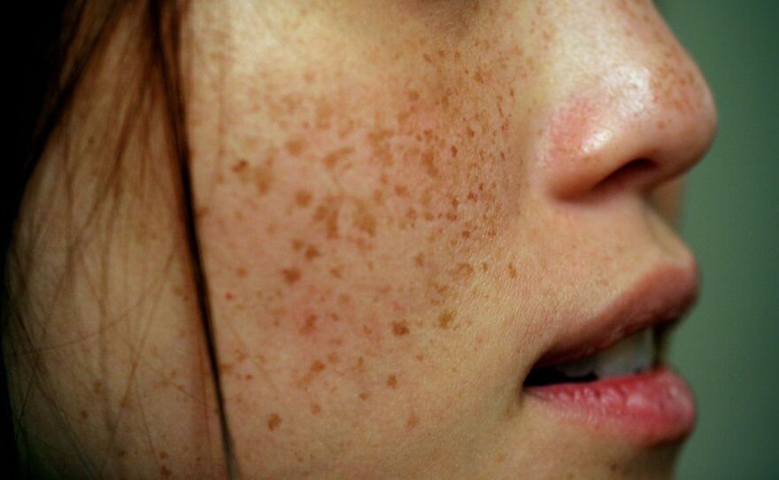 Freckles treatment