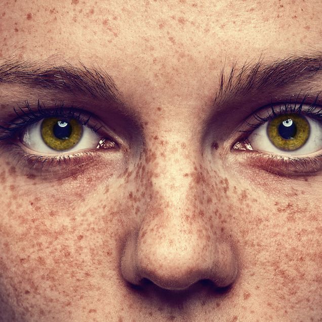 Freckles suregry indore