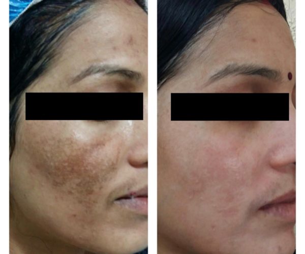 Best Melasma Treatment Doctor in indore