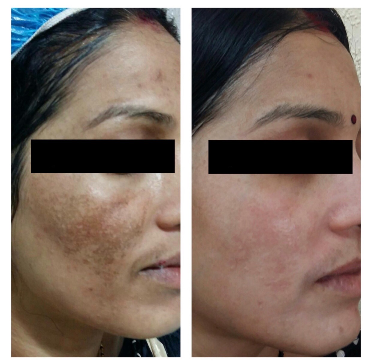 Best Melasma Treatment Doctor in indore