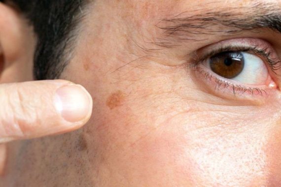 age spot treatment in indore