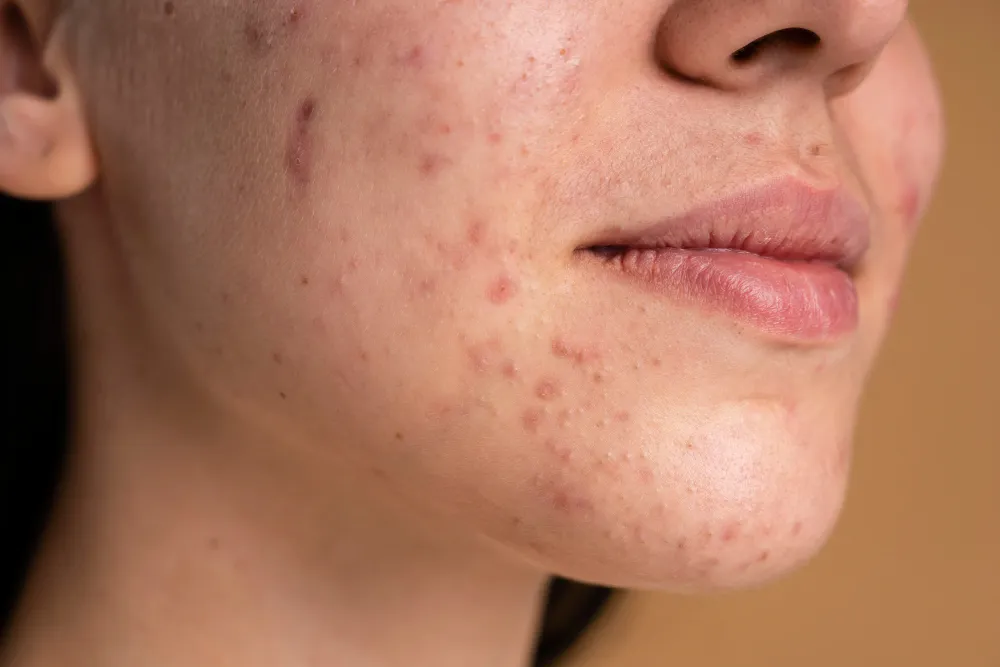 Acne Treatment in Indore