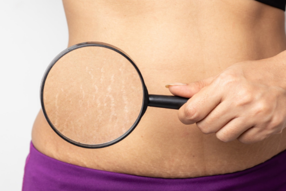 stretch marks treatment in Indore
