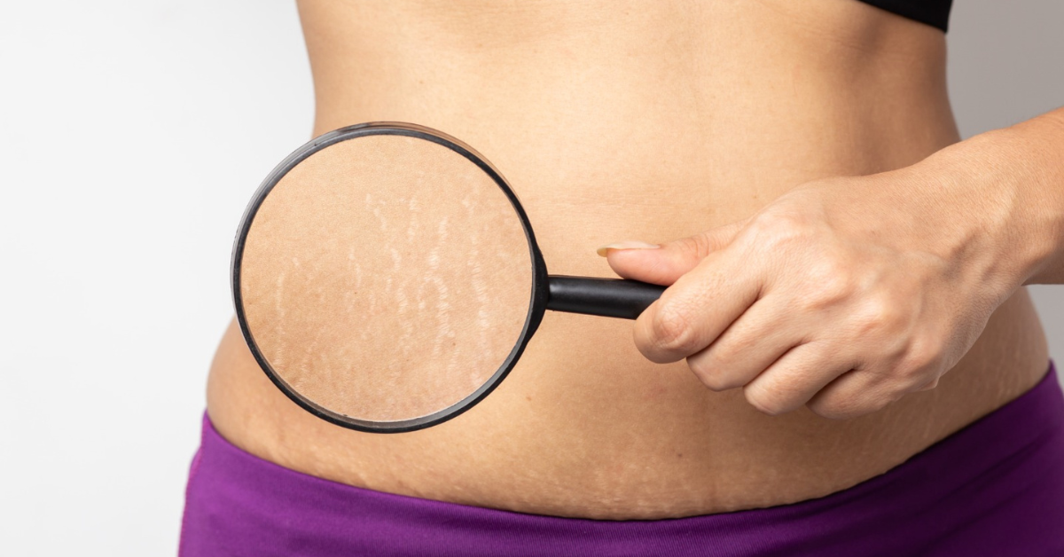 stretch marks treatment in Indore